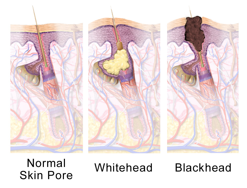 1. Keep Pores Clean